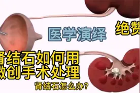 医学演绎 微创手术体内如何碎石 原来肾结石是这样清除 看完你懂视频封面