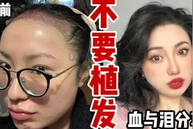 我又秃了！花了3W块哭着做的植发，一年后竟然有这么多后遗症！视频封面