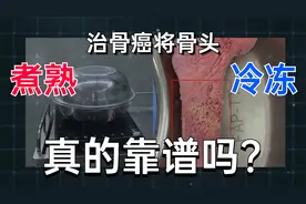把骨头煮熟或冷冻后再回植身体：这样治骨癌，靠谱吗？视频封面