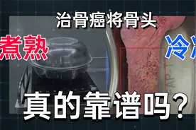 把骨头煮熟或冷冻后再回植身体：这样治骨癌，靠谱吗？