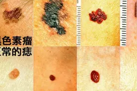 痣具有癌变风险，哪些特征的痣需要去除？介绍一下视频封面