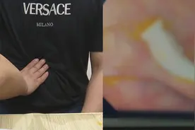 男子连续数月腹痛腹泻，检查发现肚里生虫？医生：与烹饪方式有关视频封面