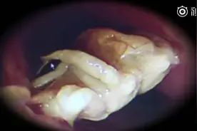 女子误吞异物卡喉 医生一查：整只螃蟹卡在食道视频封面