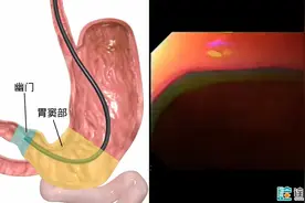 胃镜检查怎么做？