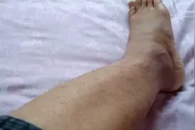 腓骨骨折下钢板脚踝部位活动受限，可能需要取出钢板以后才能恢复视频封面