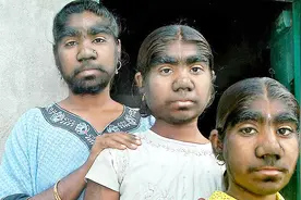 印度三姐妹从头到脚长满了毛发，为了正常生活，每隔10天就要除毛视频封面