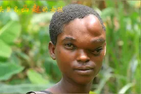 一个额头异常凸起的女孩视频封面