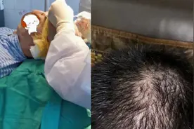 长沙24岁男子坚持健身，突然疯狂脱发最后秃了！医生：撸铁有风险视频封面