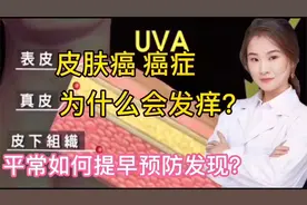 信号癌症 皮肤癌，患者身上为什么会瘙痒？如何预防和发现很重要视频封面