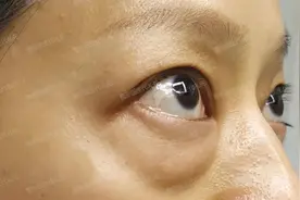 外切眼袋+眶隔脂肪释放填充+泪沟+动画演示内部操作+术前术后案例视频封面