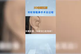 3d动画演示 耳软骨隆鼻手术全过程视频封面