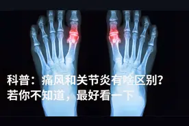 痛风和关节炎到底有哪些不同？4个最显著的区别，你都了解么？