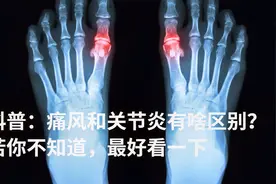 痛风和关节炎到底有哪些不同？4个最显著的区别，你都了解么？视频封面