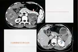 肾上腺病变的CT诊断视频封面