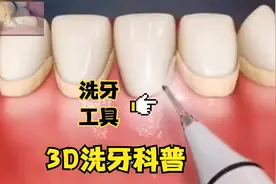 洗牙为什么会那么疼？3D效果揭秘其中原理，涨知识了！视频封面