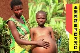 非洲男孩身患重病，肚子比孕妇还要大，在村子里受尽歧视视频封面