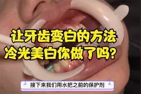 让牙齿变白的方法，冷光美白你做了吗？视频封面