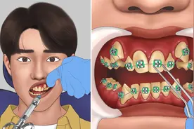 帅哥长了一口“美人龅”，第一视角矫正龅牙，过程不要太解压视频封面