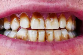 烟牙脏牙真的刷不白吗？教你几个小妙招，在家也能快速去渍白牙！视频封面