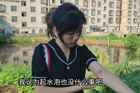 手臂突然长一堆水泡，本以为是蚊虫叮咬，检查结果却让人意外视频封面