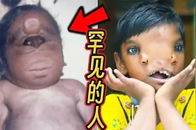 没有心脏也能活！10个最罕见的奇特人类视频封面