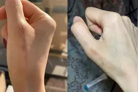 疤痕体质必备祛疤好物！疤克去疤膏轻松一抹疤痕全无！视频封面