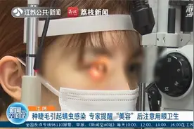 注意卫生！女子种睫毛引起眼部螨虫感染视频封面