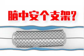 预防治疗脑梗塞能否安个支架？病理基础预防更现实视频封面