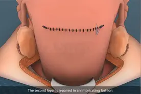 剖宫产子宫切口是怎么缝合的，你知道吗？