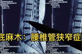 下地足底麻胀热，行走加重，休息减轻，按足底筋膜炎治疗1年无效视频封面