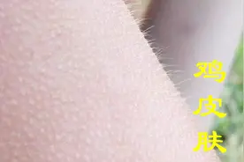 鸡皮肤分5种，对照自己辨别属那一种，学会这些解决方法轻松去除