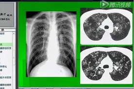 【精品-胸部：肺病变】肺结核的影像诊断与活动性的影像学视频封面