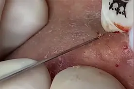 这人长了一脸的黑头，最后全挤出来看着真痛快视频封面