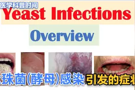 出现这些症状很可能是念珠菌（真菌）感染，尤其是老人小孩视频封面