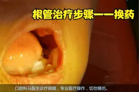 根管治疗步骤—换药，9分钟视频封面