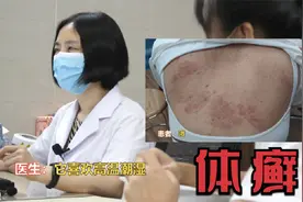 女子背部大面积体癣反复发作  瘙痒难忍  罪魁祸首是真菌视频封面