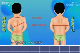 四横一竖法自测脊柱侧弯