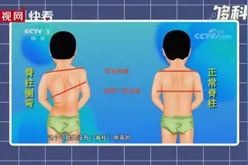 四横一竖法自测脊柱侧弯视频封面