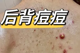 脓包断根超容易！每天成本几毛钱！粗糙后背越洗越光滑！