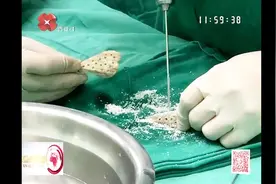 医术高超！骨科医生为病人“煮骨头”，病人顺利康复视频封面