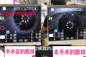 近视手术前对比未做近视手术哪个眼睛更完整？配镜老师傅带你揭秘
