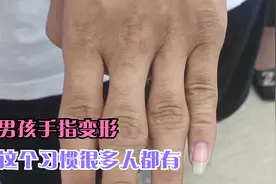 男孩手指变形，这个习惯很多人都有，千万要当心视频封面