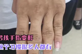 男孩手指变形，这个习惯很多人都有，千万要当心视频封面
