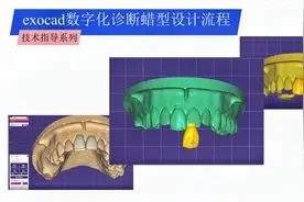 如何用exocad软件设计数字化诊断蜡型，牙宝带你学习操作流程