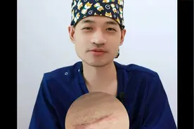 北京丽合医疗美容医院疤痕胎记：疤痕到底有什么类型视频封面