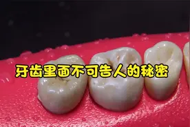 看似没有问题的牙齿里面暗藏玄机，乌黑发出的物质差点熏晕牙医视频封面