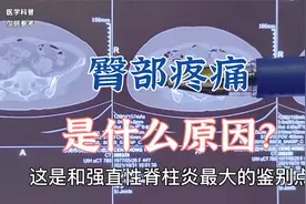 患者臀部疼痛是什么原因？骶髂关节炎要怎么治疗？听肖医生怎么说视频封面
