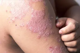 被激素治怕了，效果虽好但副作用大，银屑病新药欣比克是激素药吗视频封面