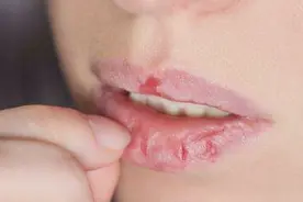 嘴唇干燥起皮不要撕，白糖加点它抹一抹，轻松搞定，方法真管用视频封面