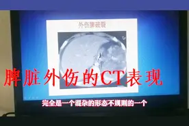 脾脏外伤在CT上是什么样的？放射科医生带你认识脾外伤。